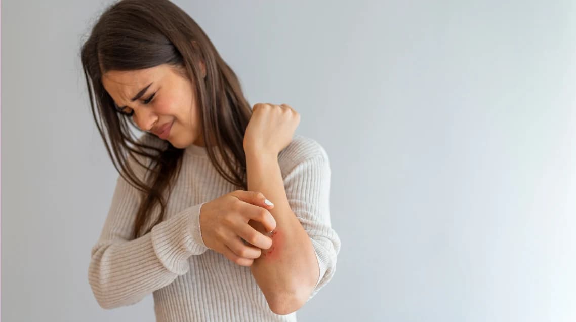 Five Types of Eczema