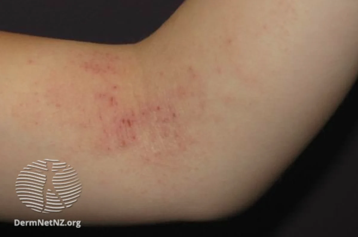 Five Types of Eczema