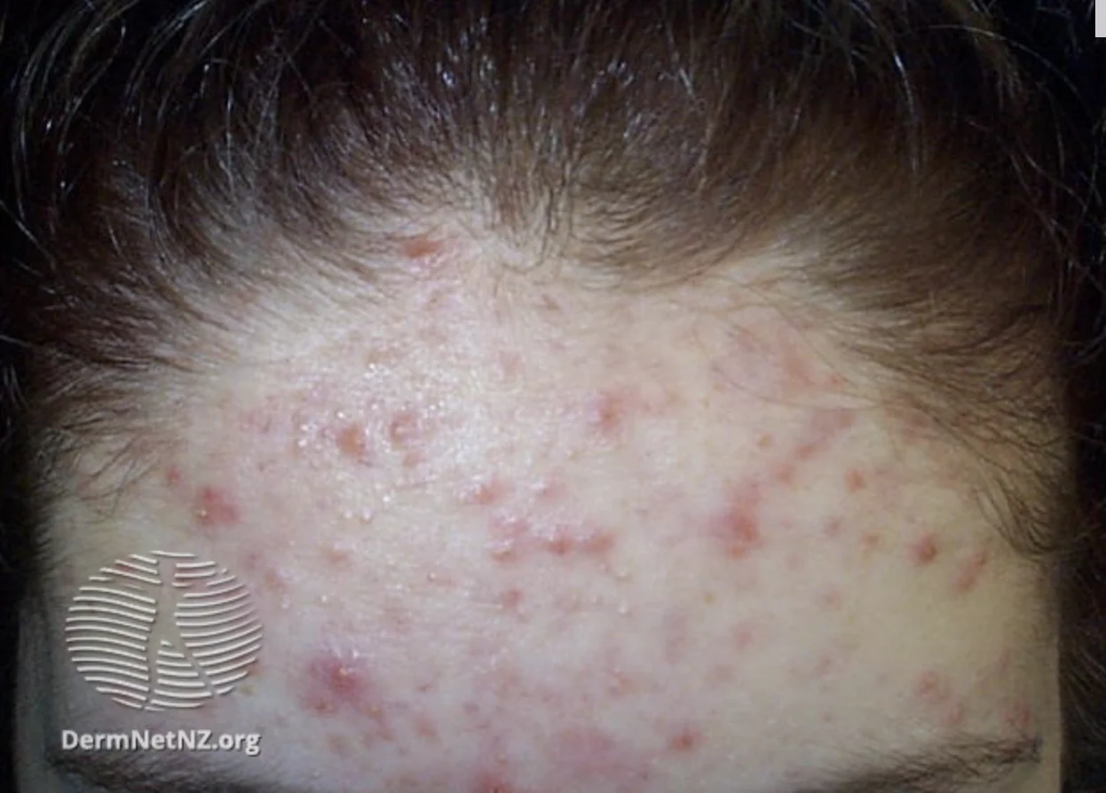 Five Types of Acne