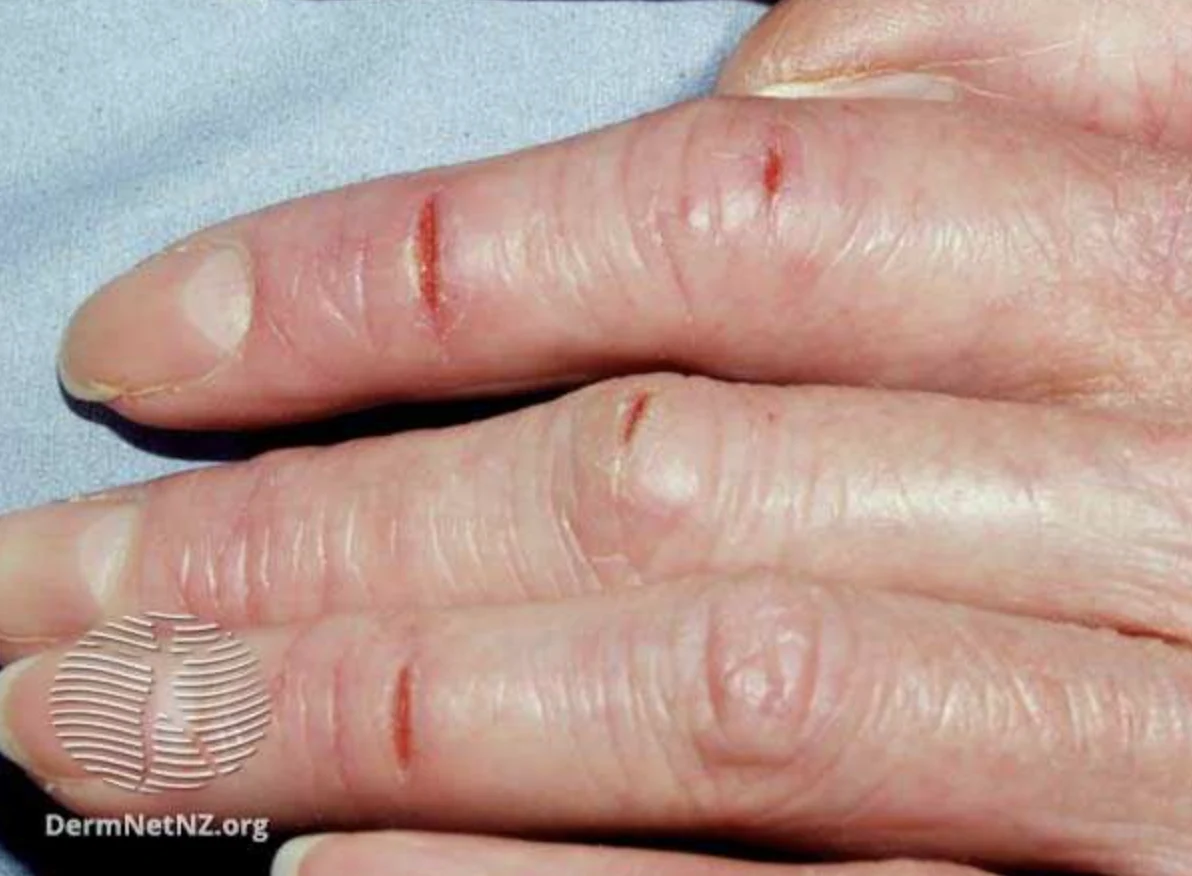 Five Types of Eczema