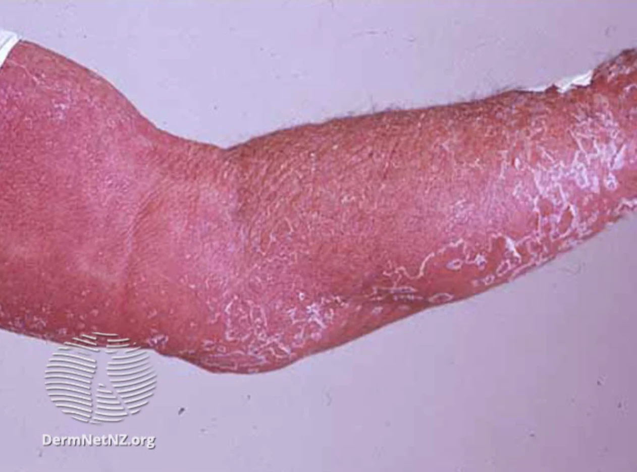 Five Types of Eczema