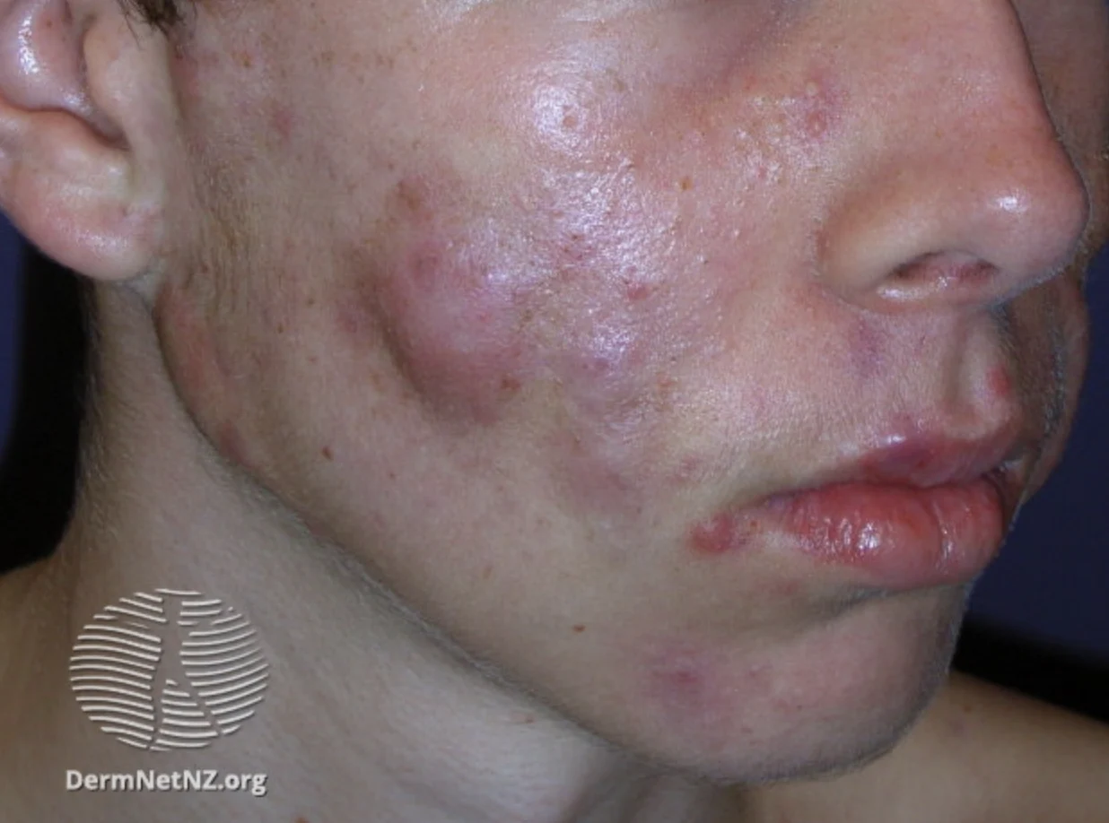 Five Types of Acne