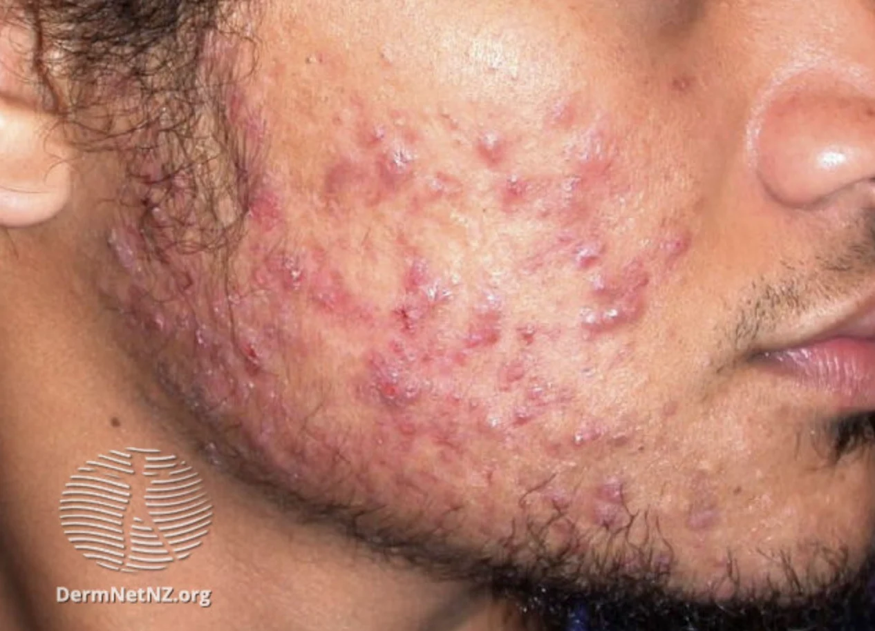 Five Types of Acne
