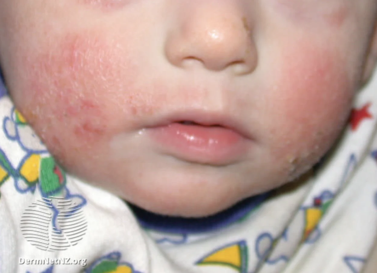 Five Types of Eczema