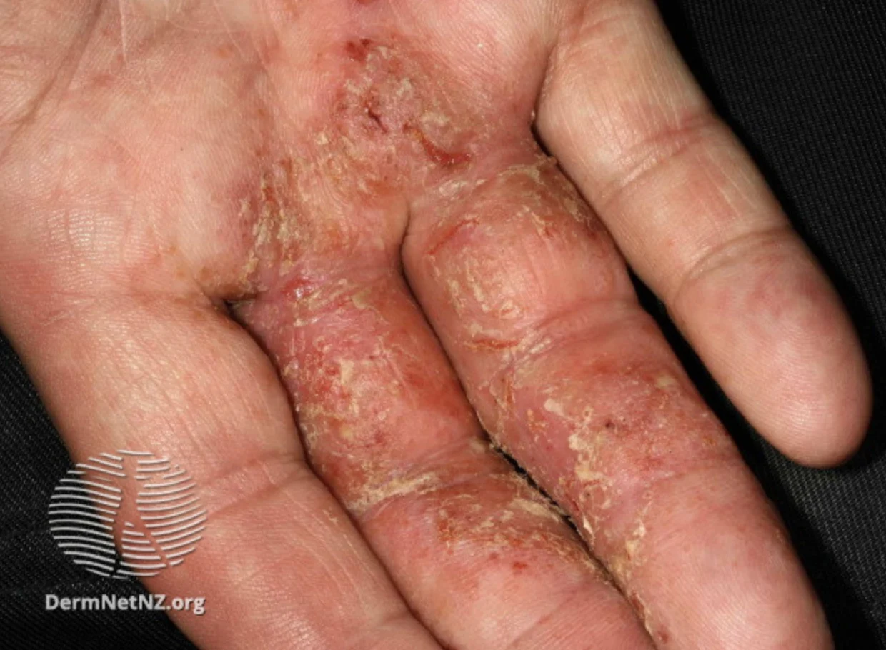 Five Types of Eczema