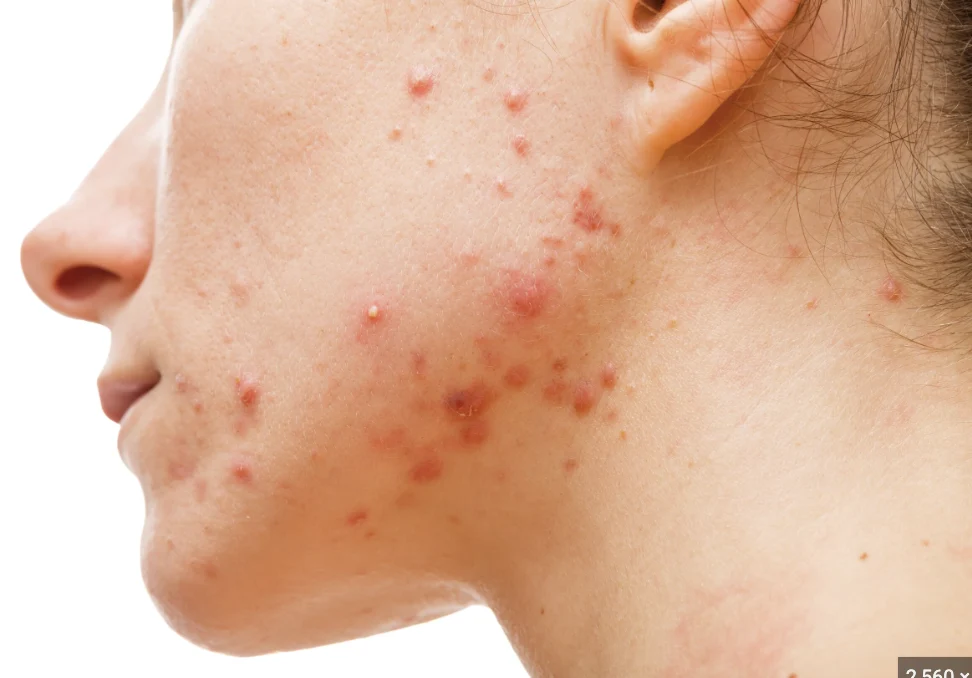 Five Types of Acne