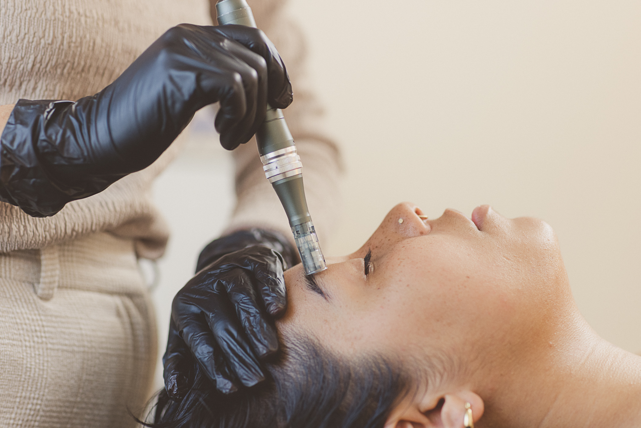 Microneedling treatment on the face